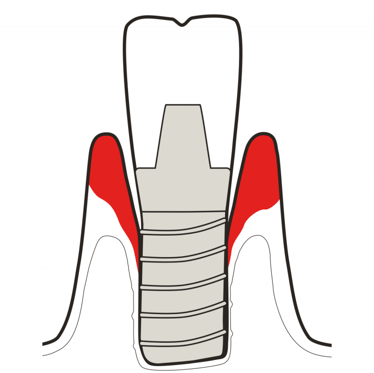 Peri-Imlantitis Icon